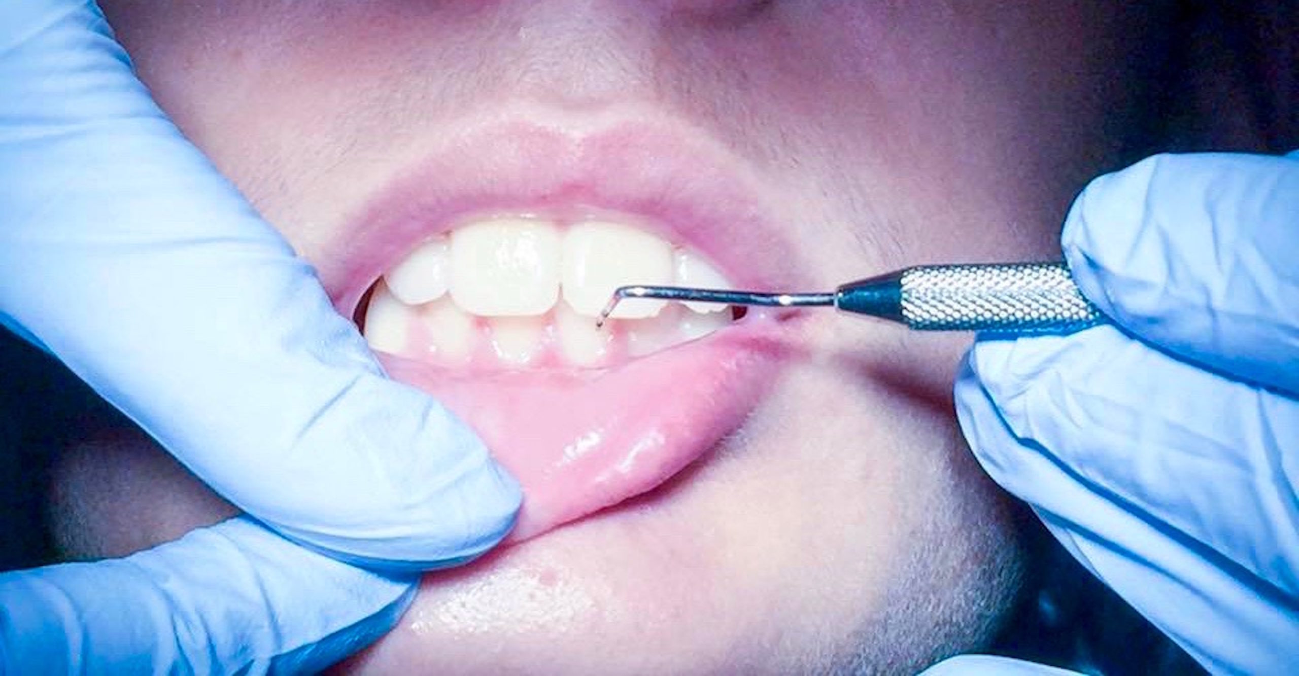 El mantenimiento periodontal