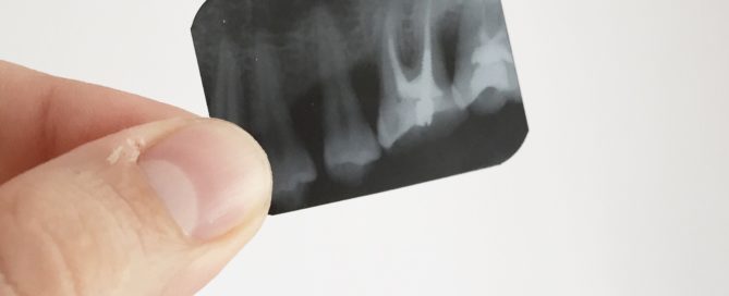 La periodontitis como factor de riesgo de la enfermedad cardiovascular