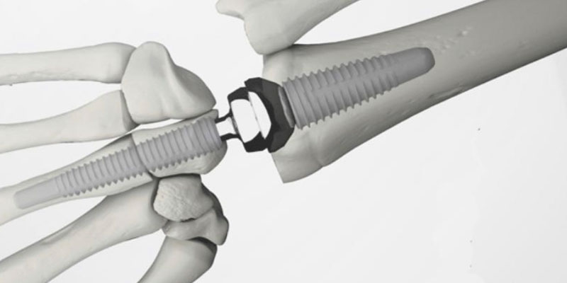 Una nueva prótesis de muñeca permite recuperar la movilidad sin dolor articular